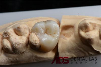 China Strong Biocompatible Dental Composite Ceramic Inlay And Onlay Restorative Services for sale