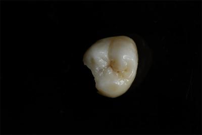 China Customizable Ceramic Inlays And Onlays In Dentistry Restoration for sale