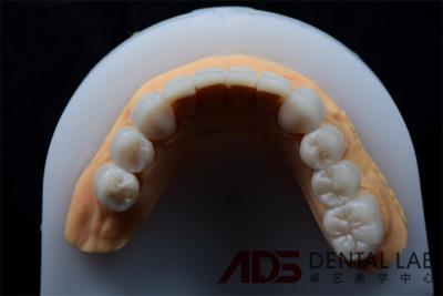 Cina Alta resistenza alle macchie Dental Emax Ceramica Veneers Corona Per Denti 400MPa in vendita