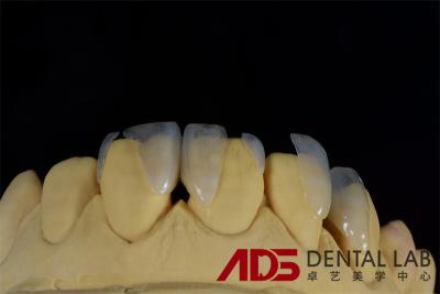 China Dentures Aesthetic Emax All Ceramic Crowns Front Teeth OEM for sale