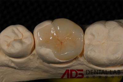 China Porcelana sin costura carillas de Emax Dentes de reemplazo de aspecto auténtico en venta