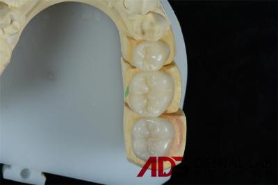 Chine Veneurs Emax en céramique 3D biocompatibles pour la restauration des dents à vendre