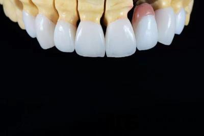 Cina OEM Veneers Dental E-Max Corone Resistenza alle macchie Minimamente invasivo in vendita