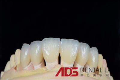 중국 Customized Dental Veneers Offer Perfect Color Match and Comfortable Fit 판매용