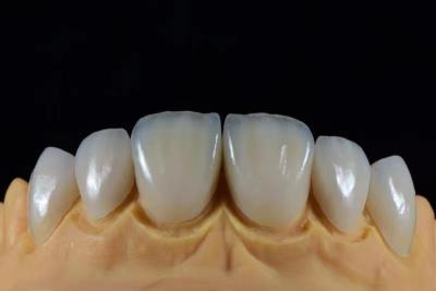 中国 Custom Emax Dental Veneer from Leading China Dental Lab 販売のため