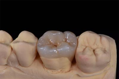 China Minimally Invasive Zirconia Crown for Natural Smile Design zu verkaufen