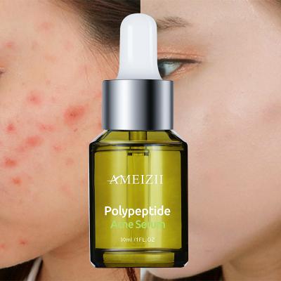 China Ameizii Remover Head Skin Acne Black Natural Brown Spot Pimple Facial Serum 30ML Peeling Solution Anti Acne Pimple Marks Polypeptide Serum for sale