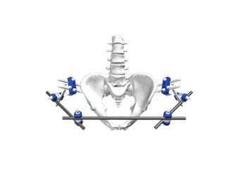 China Fijación externa de la disección IV Φ8-Pelvic del sistema de la fijación del apoyo ortopédico en venta