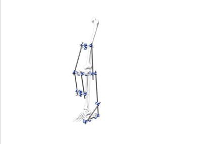 China Configuration Hybrid External Fixator For Proximal And Distal Tibia Fractures for sale