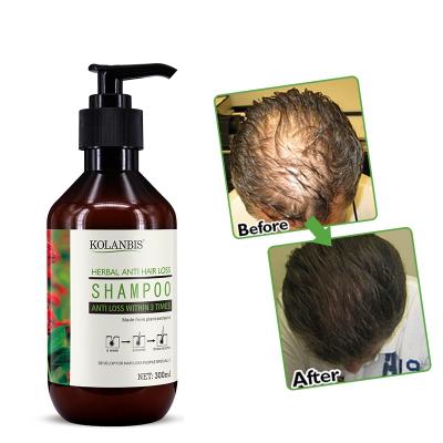 China Herbal Loss Prevention Plants Extracts Specially For Hair Loss People Anti Hair Loss Shampoo Treatment Of Hair Loss for sale