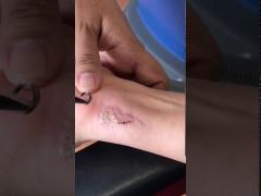 Y6 Powerful Q Switch Nd Yag Laser Effective Tattoo Removal Device