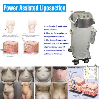 China BS-LIPS5 cannula sales body slimming power assisted liposuction machine for sale