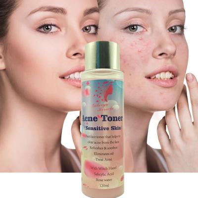 China Wholesale Toner OEM ODM Witch Hazel Salicylic Acid Rose Water Acne Treatment Blackhead Remover Soothe Face Skin Acne Toner for sale