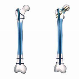 China Precice Ti Alloy Surgery Interlocking Nail Femur Mechanical Stable for sale