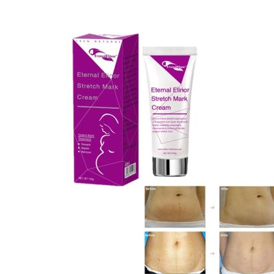 China Skin Revitalizer Up To 50% Off Elinor Stretch Mark Removal Cream OEM Eternal Scar Removal Cream Prevent Stretch Marks for sale