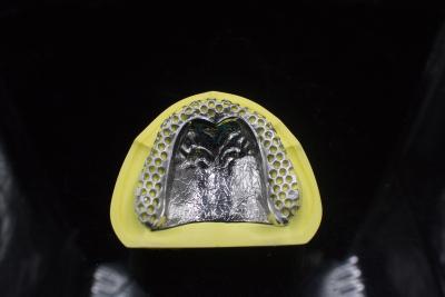 China Full Mouth Removable Dental Crown Titanium Metal Framework Partial for sale