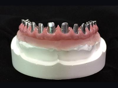 China Dentaduras permanentes de origen OEM PFM Crown Malo Bridge Malo Implant Bridge en venta