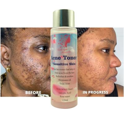 China Toner Best Face Toner Effectively Treat Acne Pimples Moisturize Brightening Repair And Soothe Skin Acne Toner for sale