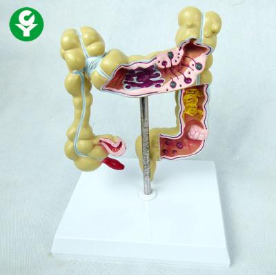 China Advanced PVC advanced diseased large intestines model for education for sale