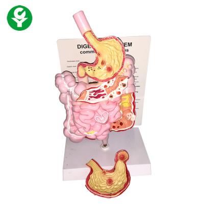 China PVC Advanced Digestive System Common Pathologies Model Anatomical Model of the Digestive System for sale