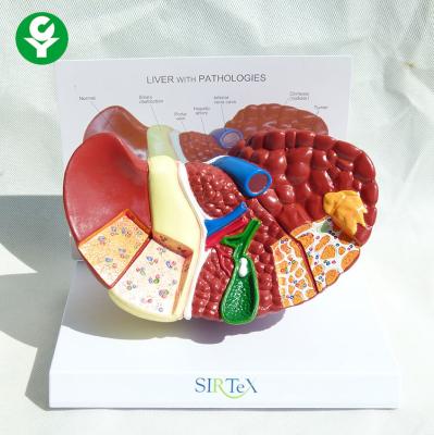 China Human Liver Model Pathological Visceral Liver Structure 3d PVC Anatomy Model for sale