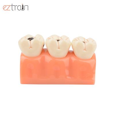 China Education Tooth Decay Evolution Model 4 Times Dental Demonstration Dental Models for sale