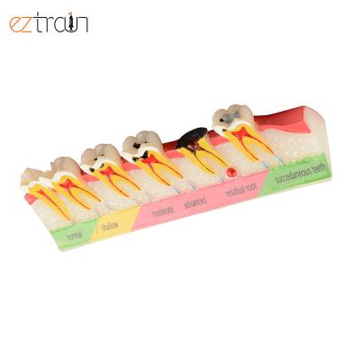 China Education Tooth Decay Evolution Model 4 Times Dental Demonstration Dental Models for sale