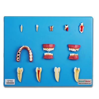 China GD/B10017 Eco-friendly Dental Diseases Model (Anatomical Model) for sale