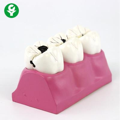 China Pathological caries Dental Teeth Model / Students Education Tooth Decay Model for sale