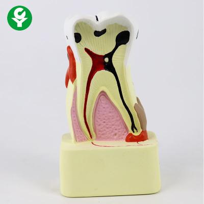 China Caries Comparison Dental Teeth Model / Dental Demonstration Models For Teaching for sale