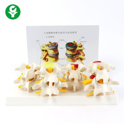 China 4 Stages Educational Body Parts Models Pathology Lumbar Vertebrae Spine for sale