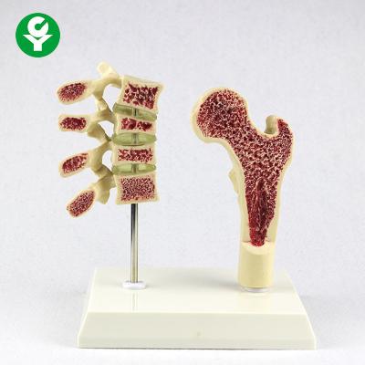 China Vertebra Thighbone Osteoporosis Model Life Size Human Lumbar Carton Packing for sale