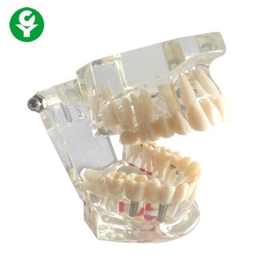 China Adult Pathology Dental Education Models Transparent Color Tooth Protection for sale