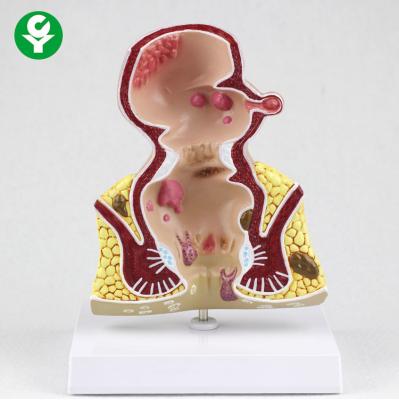 China Rectal Lesion Enlargement Pathology Model Simulation Doctor Patient Communication for sale