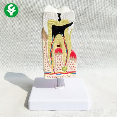 China Pathology Tooth Decay Model Dental Doctor Caries Lesions Four Times Total for sale