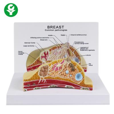 China Female Cross Section Breast Cancer Model Anatomical 1.0 Kg Single Gross Weight for sale