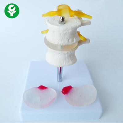 China Intervertebral Disc Model Of Two Lumbar Vertebral Bands In Human Skeleton for sale