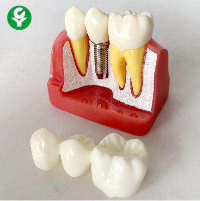 China Anatomical Patient Education Models Dental / Teeth Demonstration Model for sale