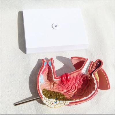 China Human Digestive System Model Stomach Gastric Diseases for sale