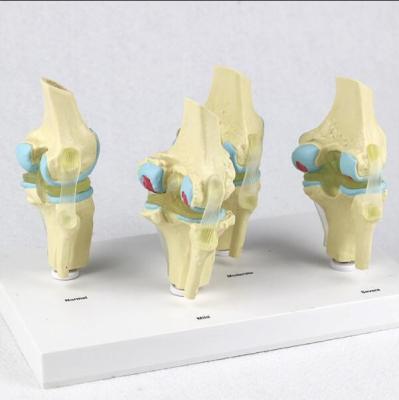 China Four Stage Pathological Learning Knee Model Anatomy for sale