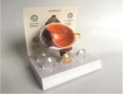 China Pathological Anatomical Cataract Eyeball Model 1.0 Kg for sale