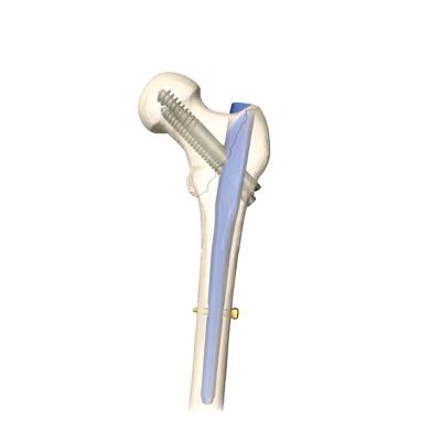 China CareFix Femur and Tibia Locking Nail, IN4 Metal Intramedullary Nail for sale