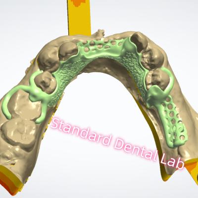 China Diseño de marco de metal Impresión láser Dentadura parcial de cromo fundido Ni ser libre en venta