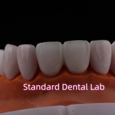 China Durchsichtig Emax Zirkonia Laminat Veneers Porzellan Zahn Veneers Chemisch verystable zu verkaufen