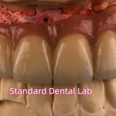 중국 CAD CAM 프레싱 PFM 금속 고정 브리지에 합성 된 비 귀금류 포르셀라인 판매용