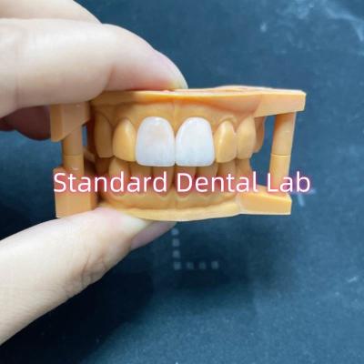 China Hohe Farbstabilität Ivoclar Emax Laminat Veneers Hohe Durchsichtigkeit zu verkaufen