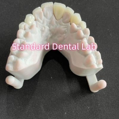 China Star's Smile Zahnzähne Emax Zirkonia Laminat Veneers 0,6 mm zu verkaufen