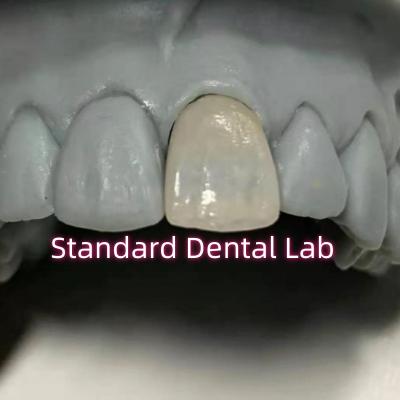 China Restorative Dentistry Emax Dental Zirconia Porcelain Crowns for sale