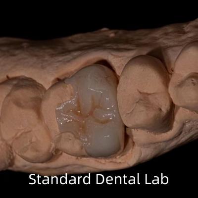 China Durchsichtigkeit Emax Zirkonia Zahn Inlay Onlay Krone zur Wiederherstellung der natürlichen Hohlraumform zu verkaufen