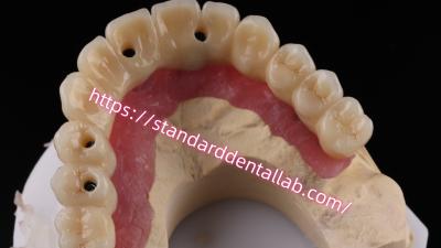 China Multi Layer Zirconia Screw Retained Implant Bridge Biocompatible On Metal Structure for sale